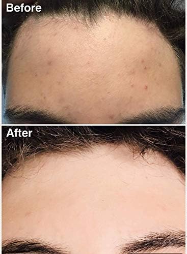 Teenology Shampoo for Teens - Avoid Forehead and Body Acne - No Sulfates or Parabens, Noncomedogenic, Natural Botanical Extracts, 16 oz. (Fresh Papaya)