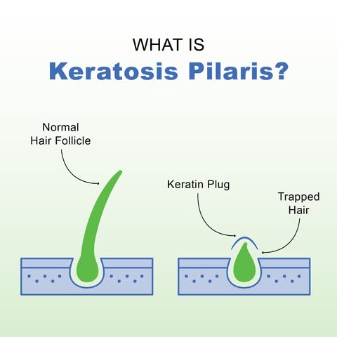 KP Elements Keratosis Pilaris Lotion (4 fl oz) - Natural Keratosis Pilaris Treatment, Moisturizing & Exfoliating AHA Lotion for KP, Vegan, Made in USA