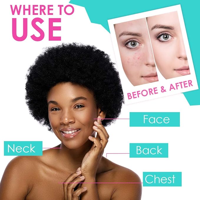 Bye Bye Blemish Acne Drying Lotion, Reduce Pimples Overnight, On-the-Spot Pimple Treatment, Beauty Skincare Essential - 1oz. (3 Pack)