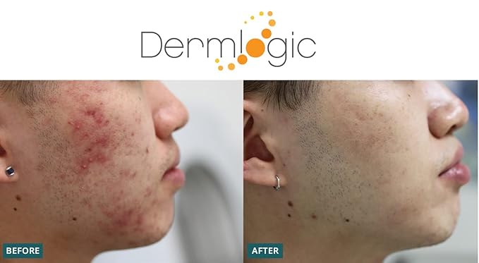 Acne Treatment Pads-Contains Glycolic, Lactic, Salicylic Acid. Eliminates Oily Skin, Clogged Pores & Cystic Breakouts. Removes Dark Spots, Whitehead & Blackhead Pimples for Face & Body.