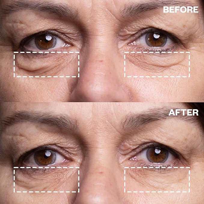Wrinkles Schminkles Under Eye Patches - Rejuvenate Wrinkles with Medical Grade Silicone Reusable Anti-Wrinkle Patches for Under Eye Treatment, Banish Dark Circles (3 Pairs)