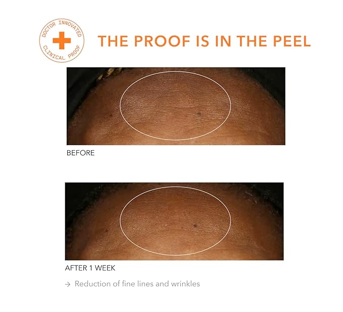 Dr. Dennis Gross Alpha Beta Universal Daily Peel: for Uneven Tone or Texture and Fine Lines or Enlarged Pores, (5 Treatments)