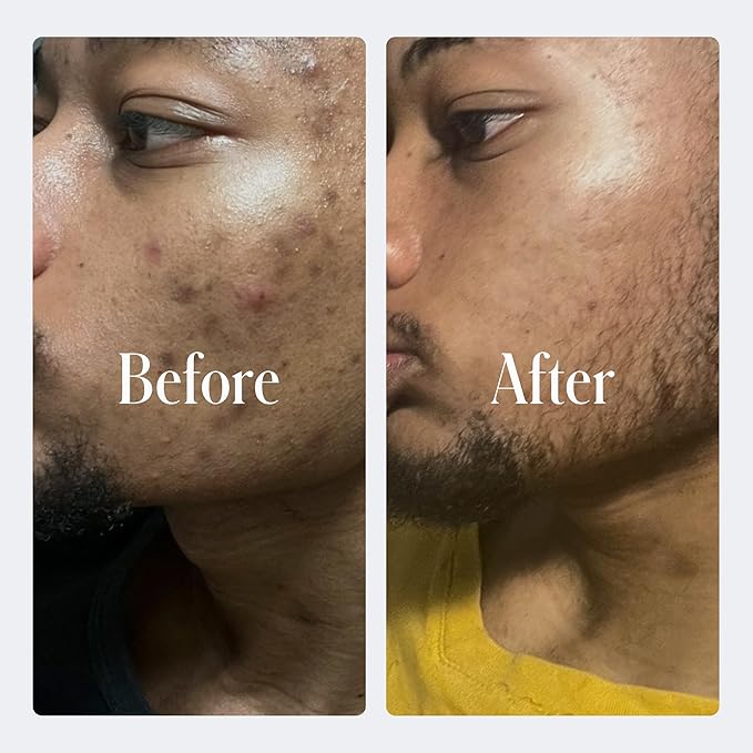 Geologie Clear System | 3-Step Acne Treatment & Skincare Set | Clears Skin Fast | Acne Gel Cleanser, SPF15 Day Cream & .3% Retinol Face Cream For Men & Women | Month 3+ / Level 3