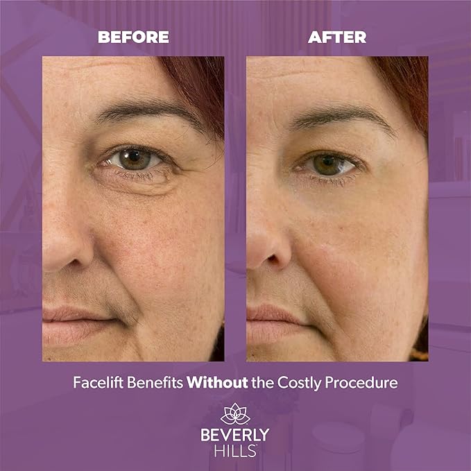Beverly Hills V-Lift Instant Eye Lift and Eye Tuck Bee Venom Serum for Puffy Eyes, Dark Circles, Wrinkles, and Under Eye Bags Treatment for Women and Men | 30mL (120 Day Supply)