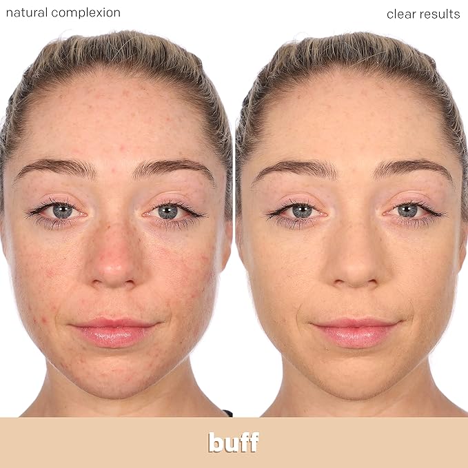 Almay Clear Complexion Acne Foundation Makeup with Salicylic Acid - Lightweight, Medium Coverage, Hypoallergenic, -Fragrance Free, for Sensitive Skin , 200 Buff, 1 fl oz.
