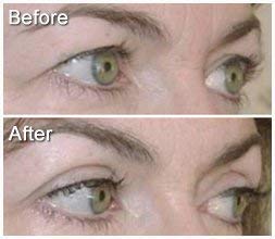 Eye Magic Original Eye Lift Kit (Small/Medium Size With Gel) Lifts Eyelid Droop and Hooded Eyes | Open And Show Off Your Beautiful Eyes | Made In America