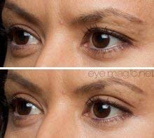 Eye Magic Original Eye Lift Kit (Small/Medium Size With Gel) Lifts Eyelid Droop and Hooded Eyes | Open And Show Off Your Beautiful Eyes | Made In America