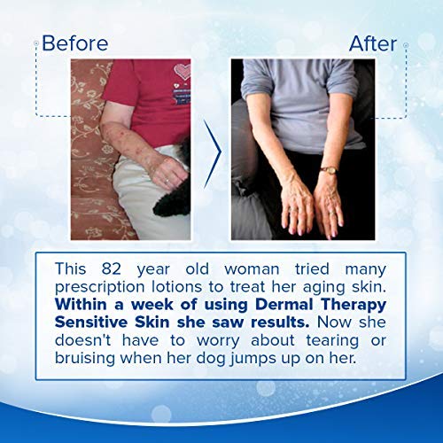 Dermal Therapy Sensitive Skin Lotion - Calming, Non-Irritating Lotion with 15% Allantoin, 10% Shea Butter, Vitamin E - Soothing Relief for Dry, Itchy, Eczema-Prone Skin - 8 fl oz / 240 ml