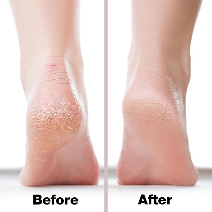 Probelle Double Sided Multidirectional Nickel Foot File Callus Remover - Immediately Reduces calluses and Corns to Powder for Instant Results, Safe Tool (Pink)