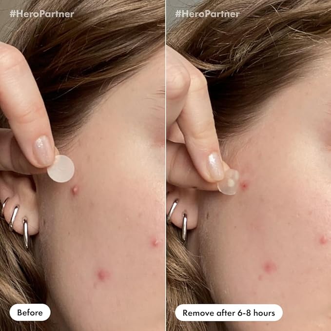 Mighty Patch™ Day and Night Patches – The Hydrocolloid Patch Duo Pack. Derm-Tested. Medical-Grade Hydrocolloid. Absorbs Pimple Gunk in 6-8 Hours. 36ct (18x Original, 18x Invisible+)