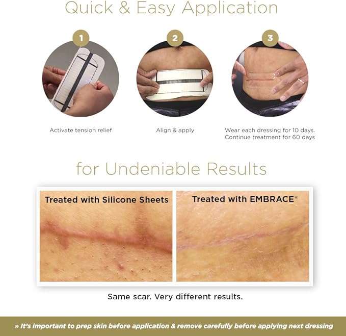 Embrace Scar Treatment, Silicone Sheets for New Scars with Active Scar Defense, Extra Large 6.3 Inch Sheets, 60 Day Supply (Recommended Treatment)