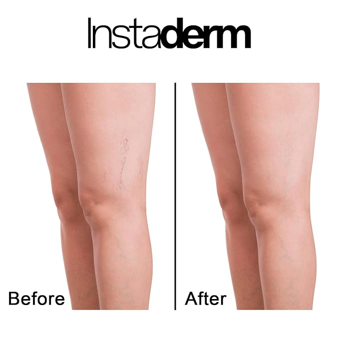 Vitamin K Cream- Bruise Healing Formula with Arnica. Dark Spot Moisturizer for Bruising, Spider Veins & Broken Capillaries. Repair Under Eye Dark Circles, & Puffiness.