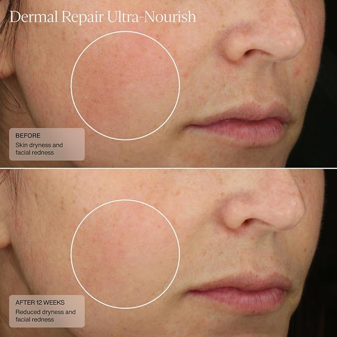 Senté Dermal Repair Ultra-Nourish - Rosacea Treatment For Dry, Sensitive Skin | Repairs, Replenishes & Reduces Skin Redness - 1.7 Fl Oz