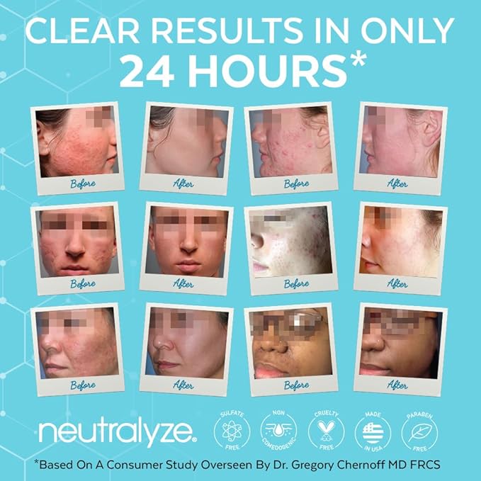 Neutralyze Moderate to Severe Acne Serum with 2% Mandelic Acid & 2% Salicylic Acid - Acne Scar & Spot Treatment for Face & Body (90 Day)
