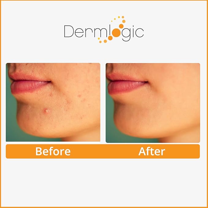 Acne Treatment Pads-Contains Glycolic, Lactic, Salicylic Acid. Eliminates Oily Skin, Clogged Pores & Cystic Breakouts. Removes Dark Spots, Whitehead & Blackhead Pimples for Face & Body.