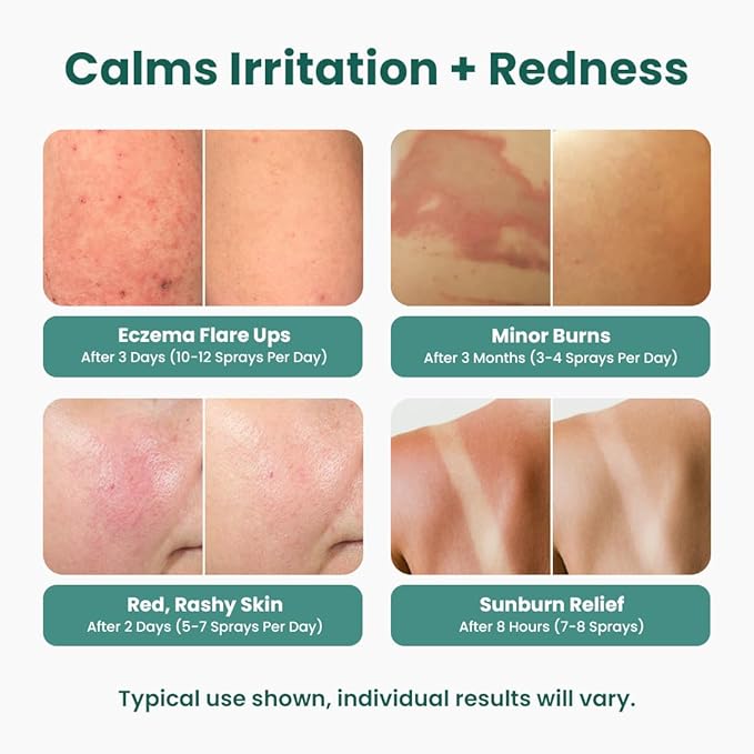 Hypochlorous Acid Spray for face (8 oz) - Face Spray for Acne, Hypochlorous Travel Size Gentle Facial & Skin Cleansing for Body, Back, Skin and Facial Cleaning & Repair - Made in USA