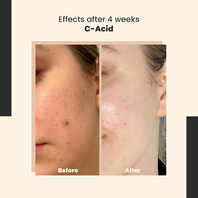 C-Acid Vitamin C & AHA Face Serum – Advanced Exfoliating and Brightening Treatment – Designed for Night Use with Lightweight Finish – 10% AHA Blend – 30 ml/Net 1.01 Fl. Oz