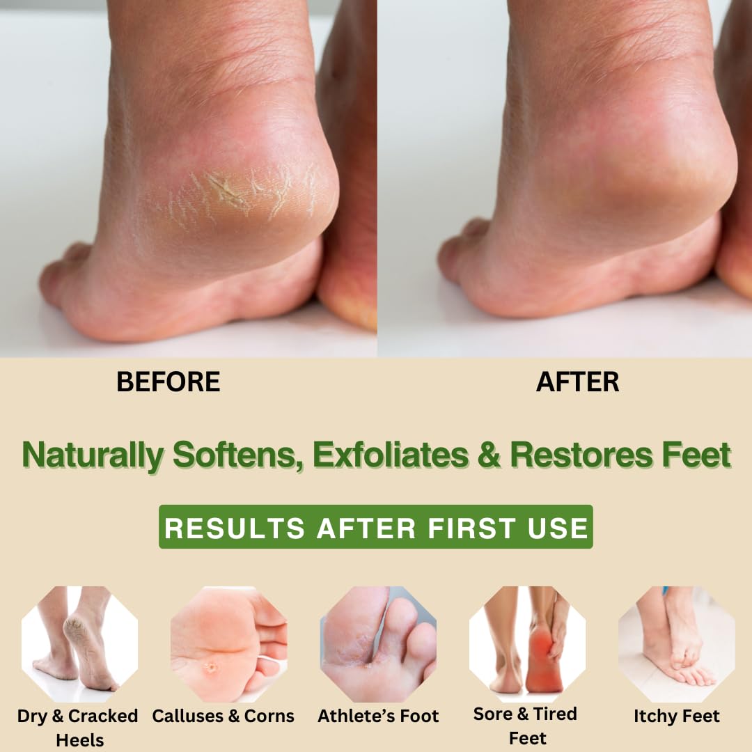 Peppermint + Rosemary, Eucalyptus & Tea Tree Foot Cream for Dry Cracked Heels and Feet - Moisturizing Foot Lotion for Cracked Heel Repair - Callus Remover with Lactic Acid (4 oz)