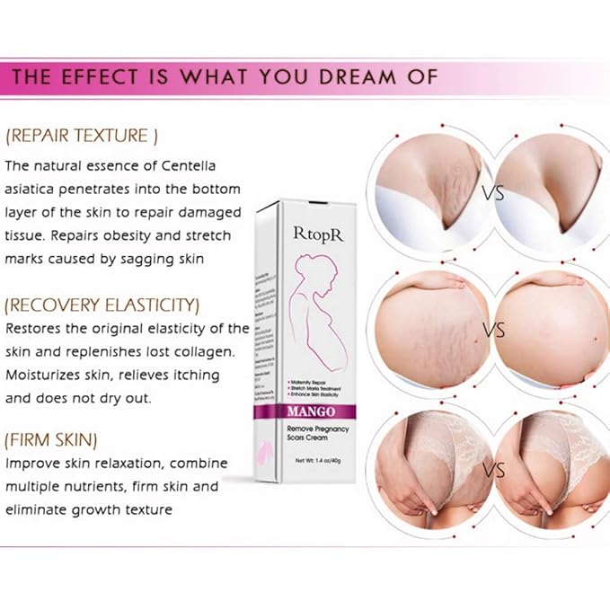 Mango Stretch Marks and Scar Cream, Stretch Marks and Scar Removal Cream for Pregnancy, Stretch Marks Scar Belly Creams for Wrinkles, Obesity Fat Stretch Mark Moisturizing, Remove Marks (40g)