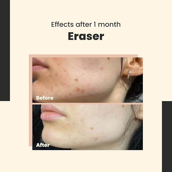 Eraser - Powerful Serum for Hyperpigmentation with 10% Vitamin C, For Dark Spots & Redness Reduction – Vegan – Safe for Daily Use – 30 ml/Net 1.01 Fl. Oz