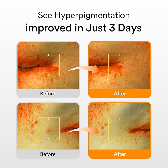 Abib Glutathiosome Dark Spot Serum Vita drop 1.69 fl.oz. | Korean Skincare, Dark Spot, Hyperpigmentation Treatment | Serum for Sensitive, Uneven Skin