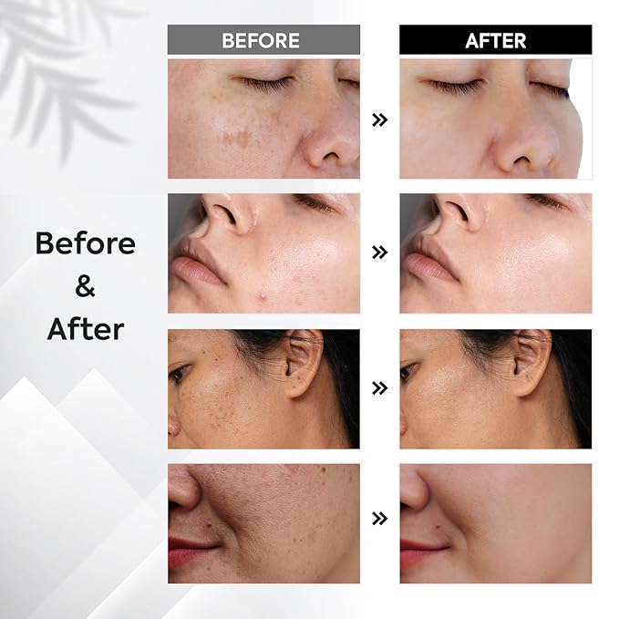 Dark Spot Remover for Face: Remove Sun & Age Spot Corrector – Melasma & Hyperpigmentation Brightening Serum for Body(Hand Leg Arm) – Brown Skin and Freckles Removal Treatment with Roller 15ml