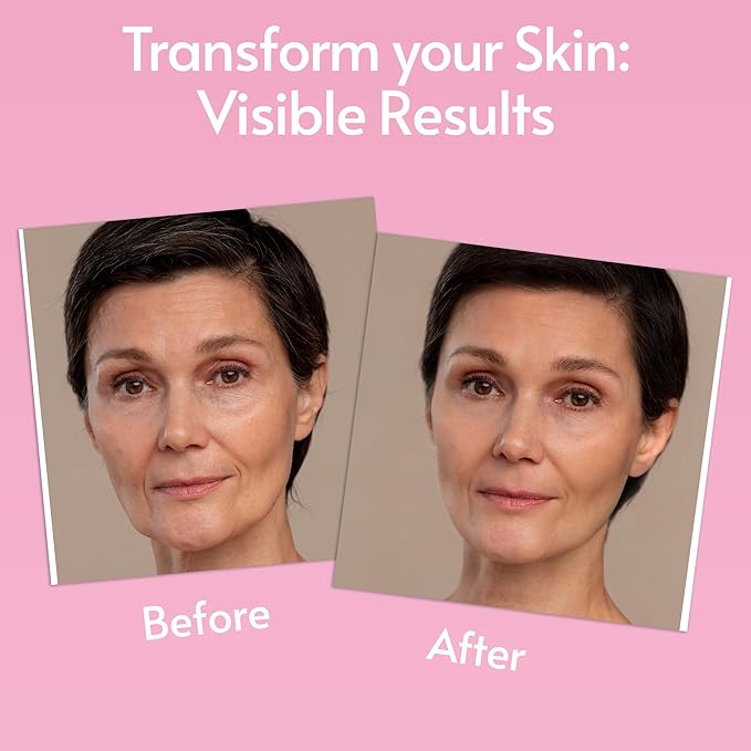 Sylk Retinol Serum for Face with Hyaluronic Acid & Vitamin E & A - Anti Aging, Fine Lines, Wrinkles, Resurfacing, Acne Scars, Skin Brightening, Dark Spots - Microneedling Retinoids for Face - 2 fl oz