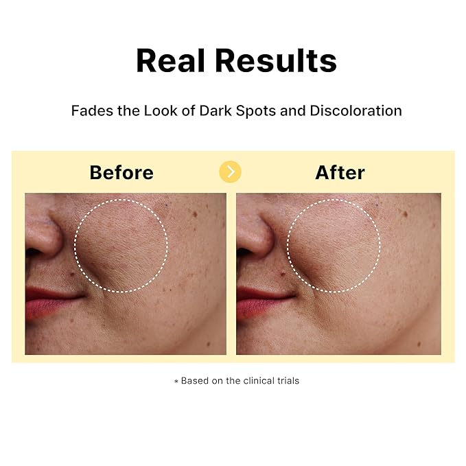 5% Tranexamic Acid Serum with 5% Niacinamide, Bakuchiol, Dark Spot Correcting Serum, Fade Discoloration, Hyperpigmentation, Acne Scars, Sun Spots, Blemish Remover, Korean Skincare,1Fl Oz