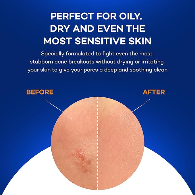 Zocular - ZocuZap Acne Face Wipes - Moisturizing Face Cleansing Wipes for Acne, Makeup Removal, and Exfoliation with Natural Okra Complex for Sensitive, Rosacea Skin - 30/ct