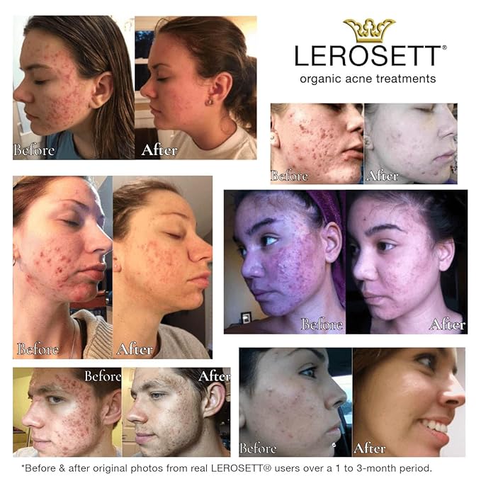 LEROSETT Botanical Acne Cleanser, Foaming Gel Face Wash for Acne Prone, Vegan, Blackheads & Oily Skin 50% Calming Aloe, 2% Salicylic Acid, All Skin Types. Vegan - 6.7oz 60-Day