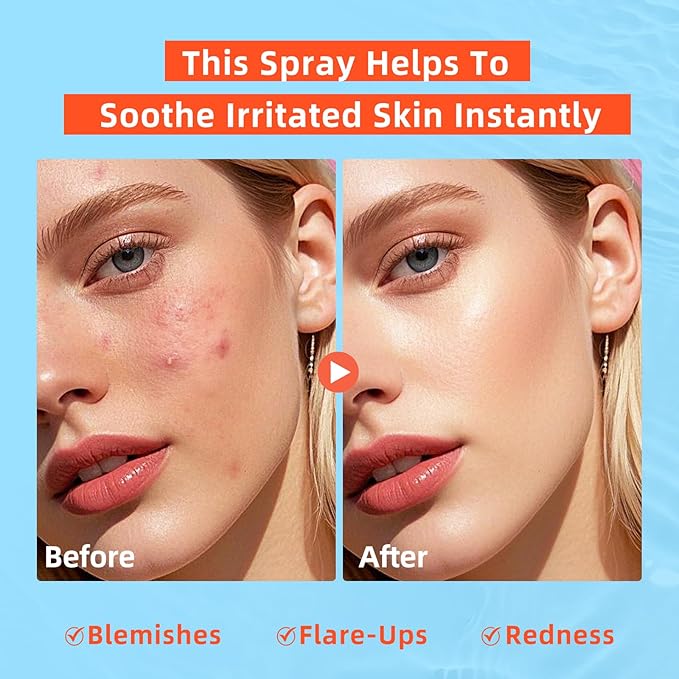 Hypochlorous Acid Spray: Facial Spray Hypochlorous Acid Spray for Face, Soothes Sensitive Skin, Reduces Irritation, Clears Pores, First Aid Relief, 3.38 FL Oz