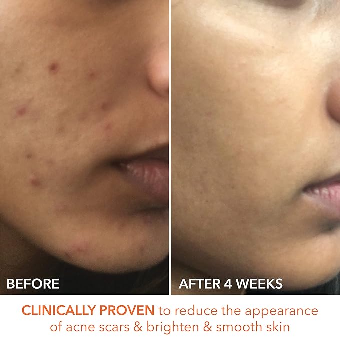 Dr. Dennis Gross Alpha Beta Extra Strength Daily Peel – 2-Step Exfoliating Pads for Enhanced Anti-Aging, Smoother Skin, and Radiant Complexion, 60 Treatments