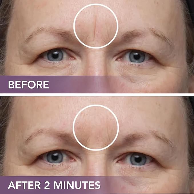 Dermaflage Scar Filler Kit - Medium - Deep Scar Cover and Waterproof Concealer for Acne Scars Wrinkles, and Ice Pick Scars Makeup, 1 mo supply