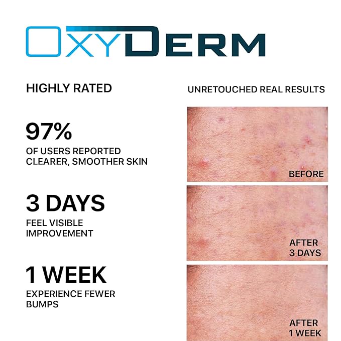 Butt & thigh Acne Treatment Pads - Exfoliating Pads to Eliminate Acne Causing Bacteria. Removes Pimples, Blemishes & Ingrown Hairs for the Buttocks & Thigh Area for Both Men & Women.