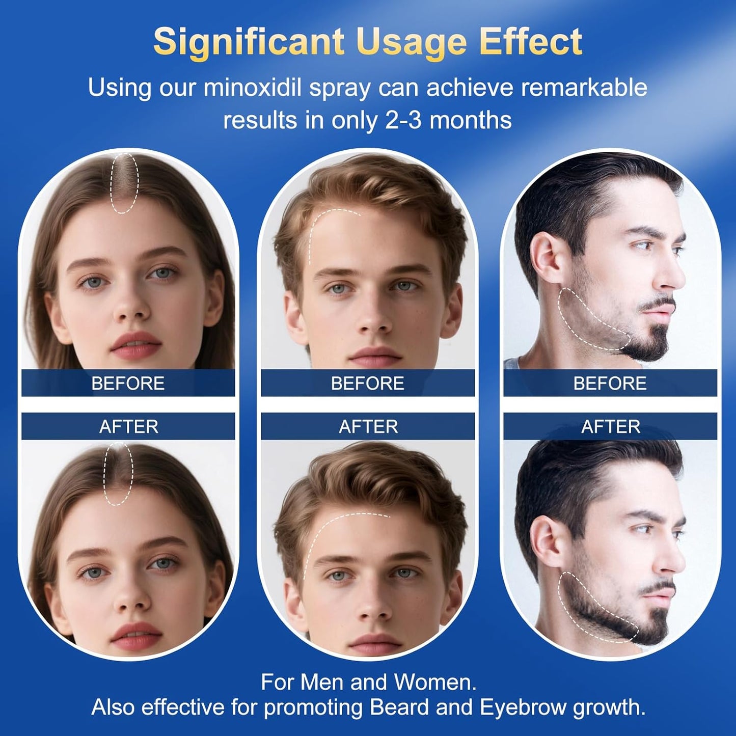 5% Minoxidil Spray for Men & Women - Hair Growth Serum & Hair Regrowth Treatment | Extra Strength with Biotin | 12-Month Supply 8-Pack (28 fl oz) | Clinically Proven for Hair Loss & beard growth