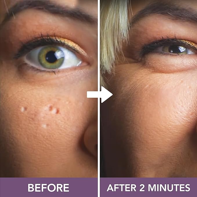 Dermaflage Scar Filler Kit - Light Tan - Deep Scar Cover and Waterproof Concealer for Acne Scars Wrinkles, and Ice Pick Scars Makeup, 1 mo supply