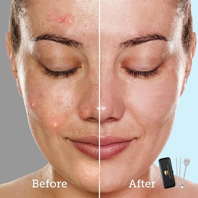 LitBear Pore Prep Tool, Blackhead Remover Pimple Popper Tool Kit, Stainless Steel Blackhead Extractions Tool for Acne, Whitehead Popping, Blemish, Comedone, Black