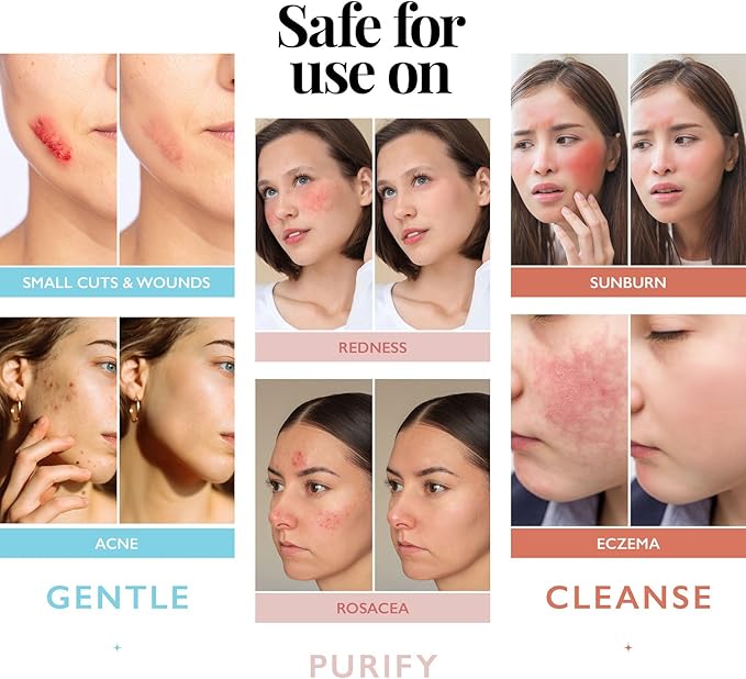 Hypochlorous Acid Spray for Face and Skin | Piercing Aftercare Spray | 8 oz Hypochlorous Acid Sprays for Face, Skin, Acne, Eczema, Body Acne Sprays, Piercing Aftercare, Facial Wound Solution, Workout