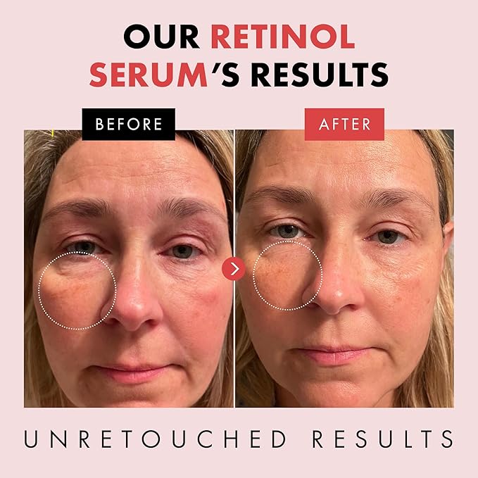 Eclat Skincare Renewing Retinol Serum for Face - Anti Aging Serum with Hyaluronic Acid & Aloe Vera – Hydrates and Improves the Signs of Aging (Fine Lines, Wrinkles & Dark Spots) 1 Fl Oz