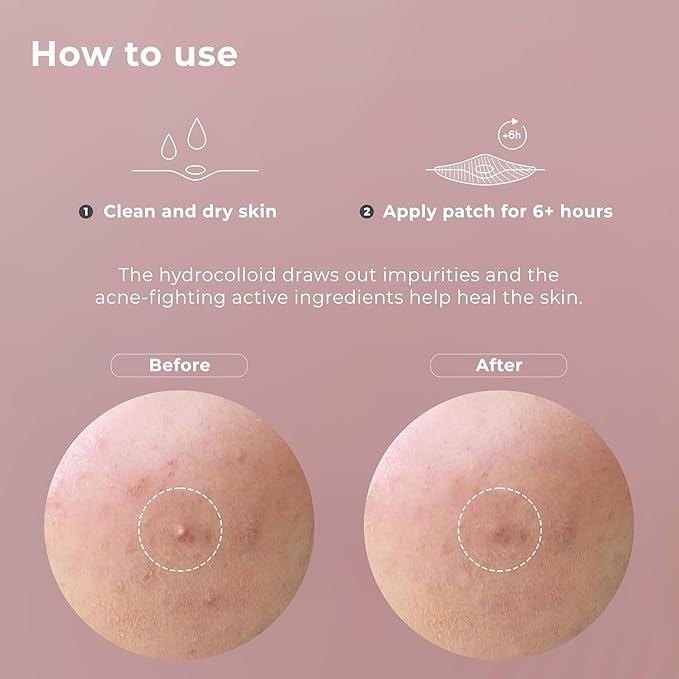 OMMA 72 Patches Pimple Patches for Face and 18 Micropoint Acne Patch Bundle