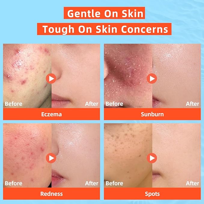 Hypochlorous Acid Spray: Facial Spray Hypochlorous Acid Spray for Face, Soothes Sensitive Skin, Reduces Irritation, Clears Pores, First Aid Relief, 3.38 FL Oz