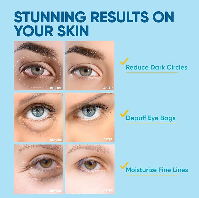 Under Eye Patches for Anti-Aging: 30 Pairs Retinol Collagen Gel Eye Pads - Reduces Wrinkles, Dark Circles, Eye Bags & Puffiness, Fine Lines Smoothing Treatment & Hydrating Eye Mask for Women