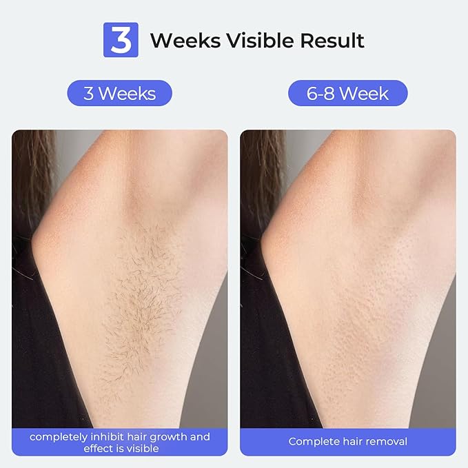 LUBEX Painless Sapphire Ice Cooling IPL Laser Hair Removal Device at Home for Women & Men, 1,000,000+ Unlimited Flashes, Safe and Permanent, Alternative to Salon Hair Removal for Face, Body, Bikini