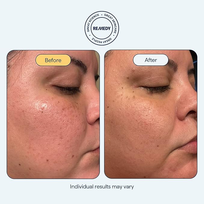 Remedy for Light Moisture - Barrier Repairing Hydrating Lightweight Gel Moisturizer Water Cream for Normal to Oily Skin - By Dermatologist Dr. Shah, 1.7 fl. Oz