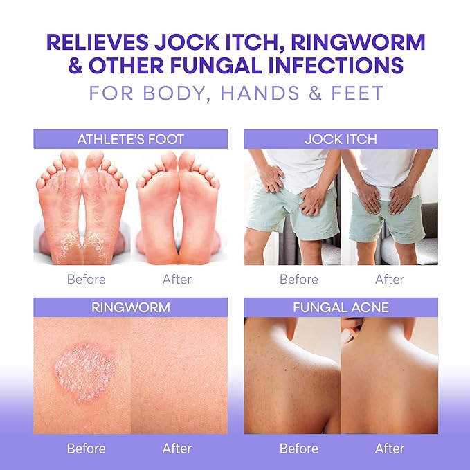 Hermon Antifungal Soap with Tea Tree Oil: Antifungal Bar Soothing Care & Relief of Itchy for Ringworm Jock Itch Tinea Versicolor Athletes Foot - Body & Face Wash - Lavender