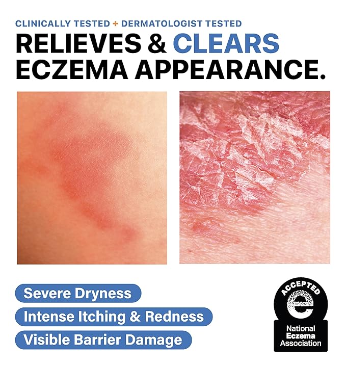 Eczema Cream for Adults & Kids – Hypoallergenic Barrier Repair Moisturizer, Clinically Proven (3 Studies), Fragrance-Free, Dermatologist Tested, Face & Body Hydration, NEA Accepted, USA Made