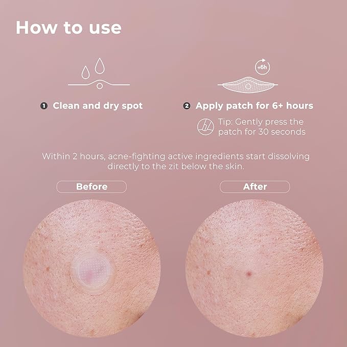 OMMA Korean Microdart Acne Patch, Cystic Acne Treatment, Micropoint Pimple Patches for Face for Early-Stage Painful Zits, Salicylic Acid & Tea Tree - 14 mm Zit Stickers (18 Count)