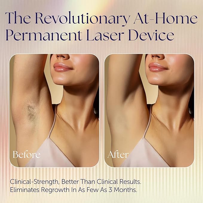 Epilaser At-Home Laser Hair Removal Device for Light Skin, Safe, Intelligent, Painless and Permanent Hair Removal for Face, Body, Bikini Line (Light Skin)