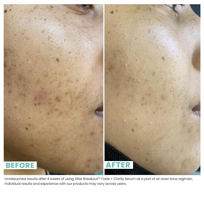 Urban Skin Rx, Acne & Dark Spot Essentials Starter Kit, Includes Clear Skin Cleansing Bar, Acne Serum + Spot Treatment & Fade + Clarify Serum, Cleanses Pores, Fades & Fights Breakouts