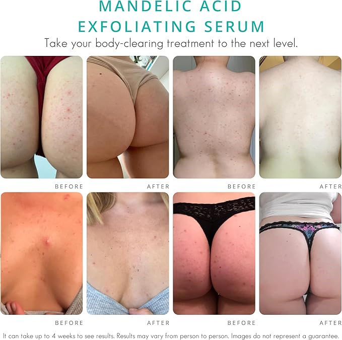 Body Clearing Serum [1 Fl Oz] Level 2 Acne Serum - Advanced Formula for Body Acne, Folliculitis, Back, Butt, Chest, Thighs, Shoulders - Mandelic Acid